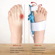 Adjustable Bunion Support Splint – Hallux Valgus Corrector for Men & Women - dailyneed.life